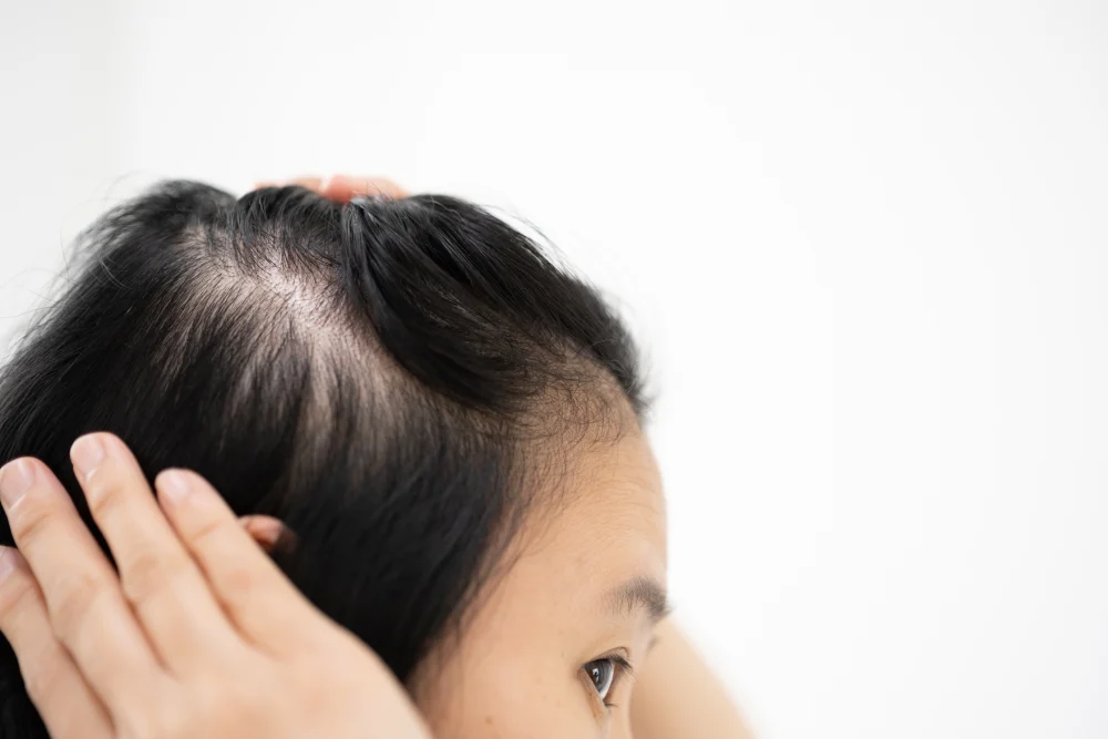 Woman examining thinning hair in a mirror. 
