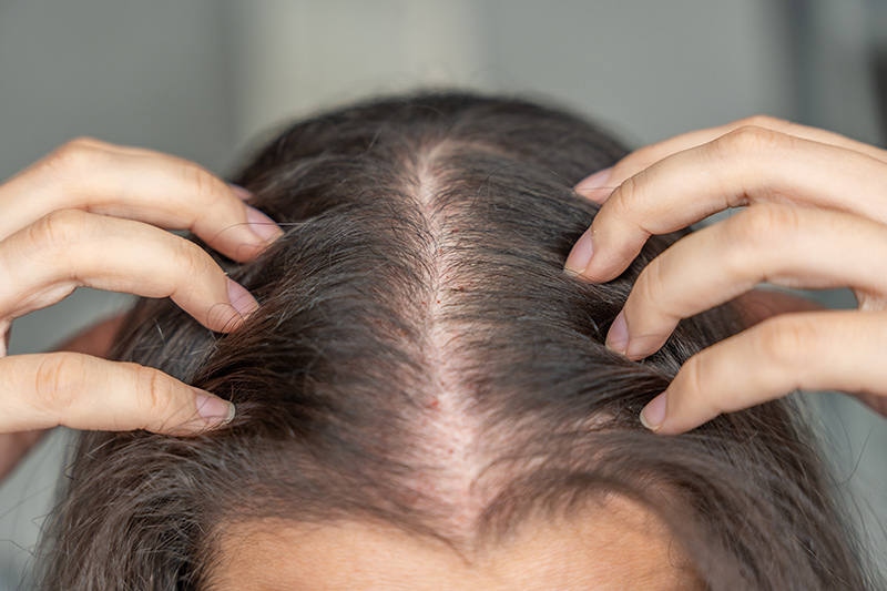 Close-up of a balding scalp showing thinning hair.